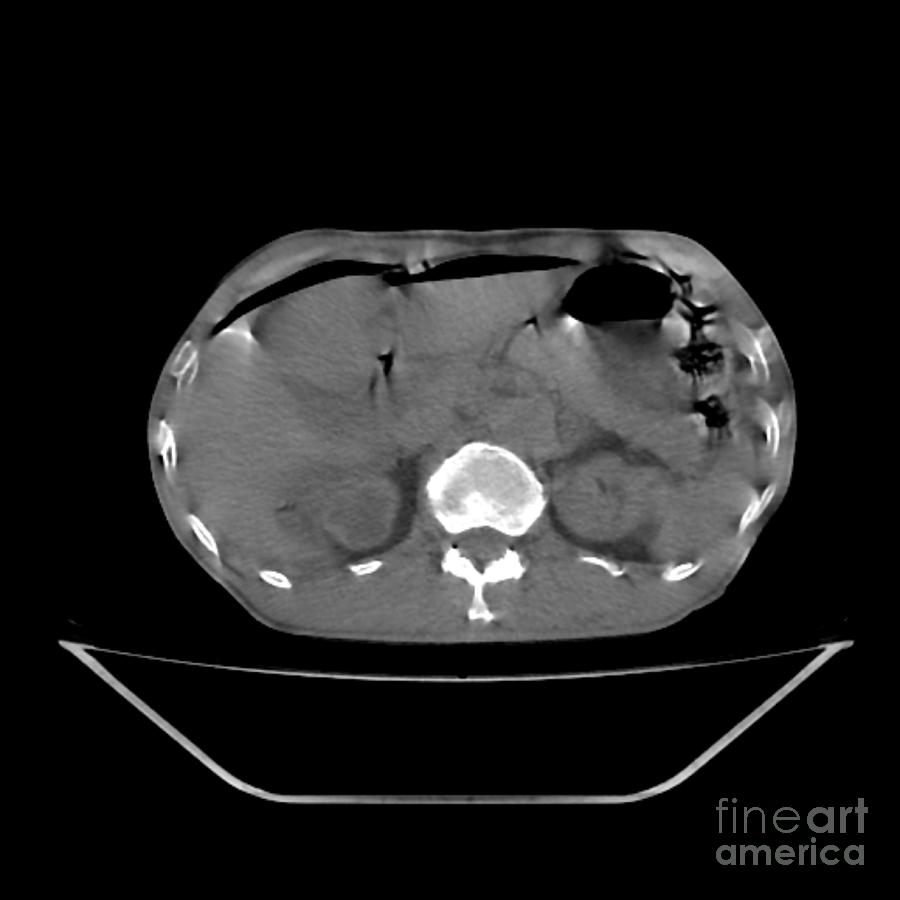 Pneumoperitoneum Photograph by Rajaaisya/science Photo Library - Fine ...