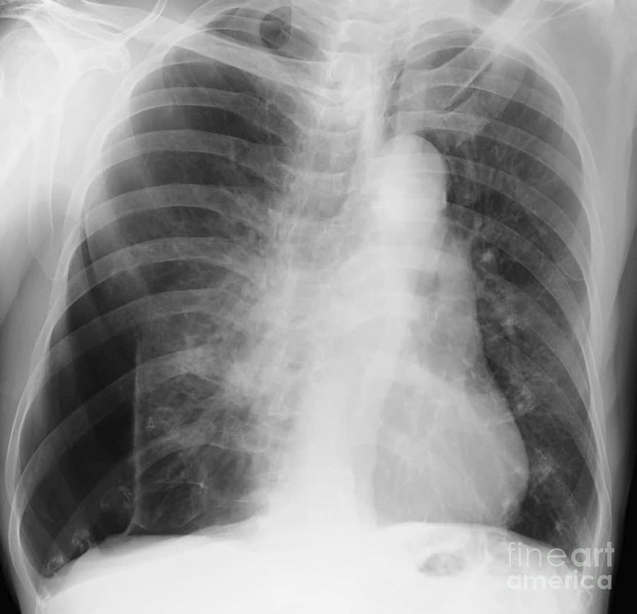 Pneumothorax Photograph by Rajaaisya/science Photo Library - Fine Art ...