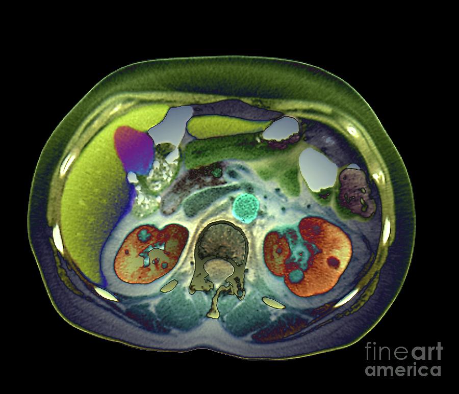 Pyelonephritis Photograph By Zephyrscience Photo Library Fine Art