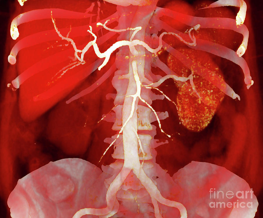 Renal Artery Thrombosis #8 Photograph by Vsevolod Zviryk/science Photo Library