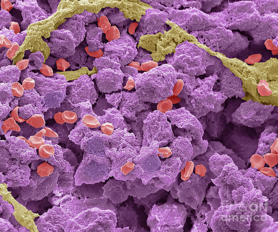 Sarcoma #8 Photograph by Steve Gschmeissner/science Photo Library
