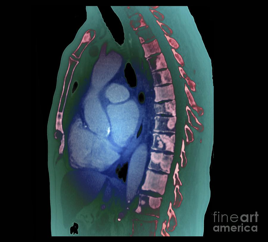 secondary-bone-cancer-in-the-spine-photograph-by-zephyr-science-photo