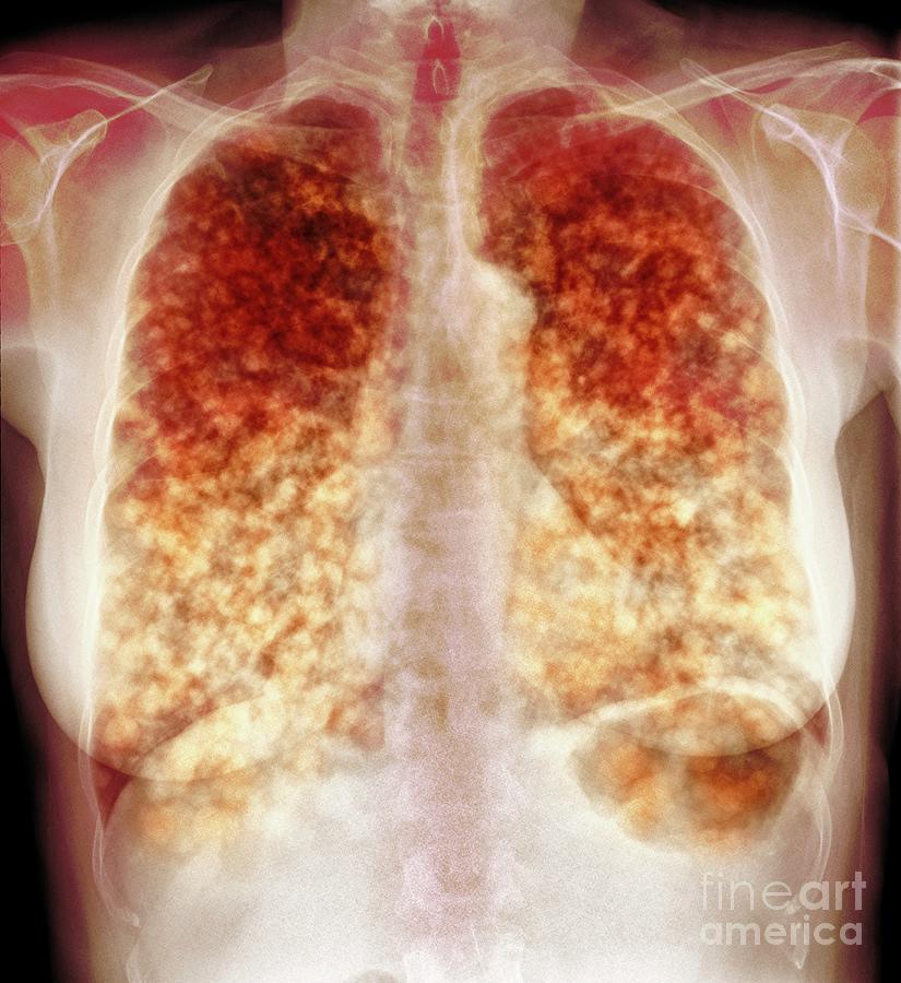 secondary-lung-cancer-photograph-by-science-photo-library-pixels