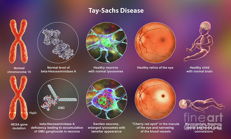 Tay-Sachs Disease: Signs and Symptoms