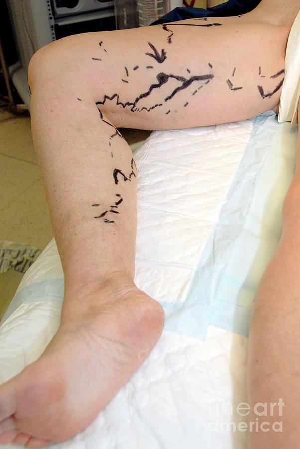 Varicose Vein Removal Photograph by Aj Photo/science Photo Library - Pixels