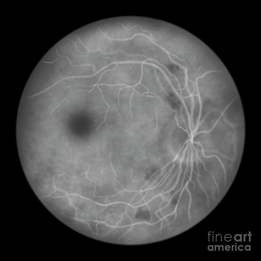 Retina Damage From Diabetes #85 Photograph by Kateryna Kon/science Photo Library