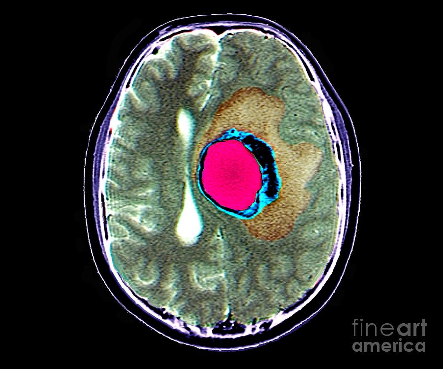 Brain Cancer Photograph by Zephyr/science Photo Library - Fine Art America