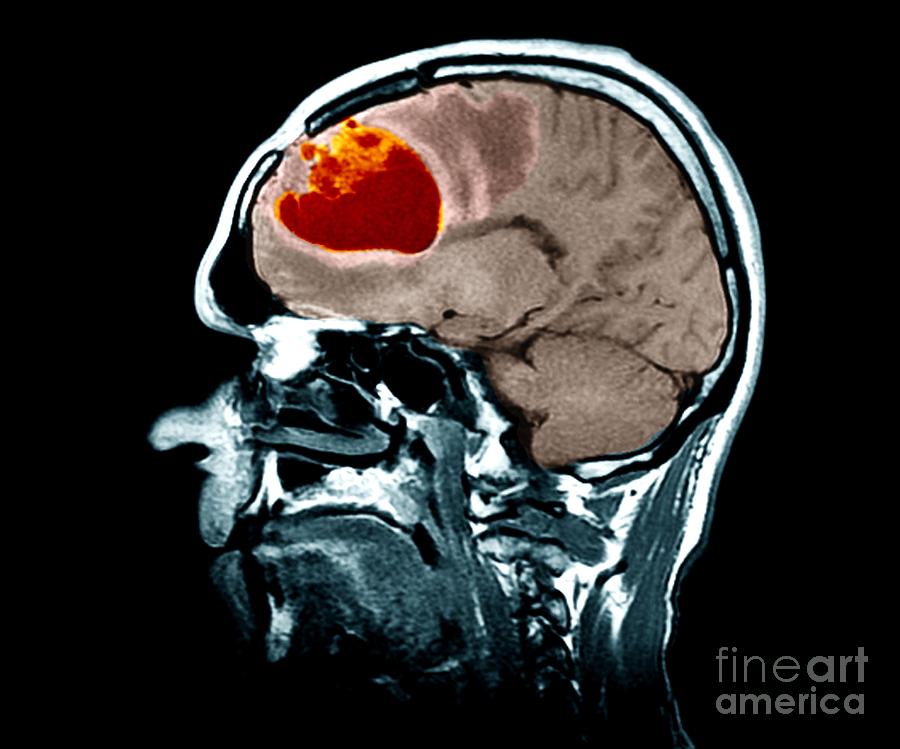 Male Photograph - Brain Tumour #9 by Zephyr/science Photo Library