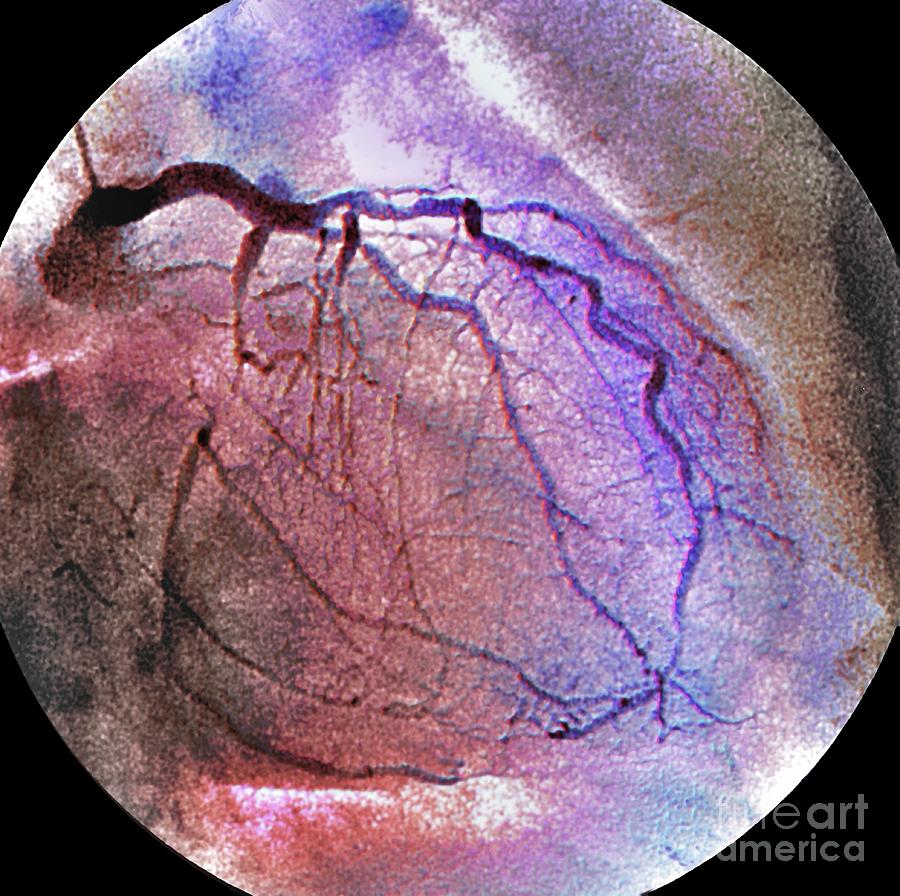 Coronary Artery Stenosis Photograph By Zephyr/science Photo Library