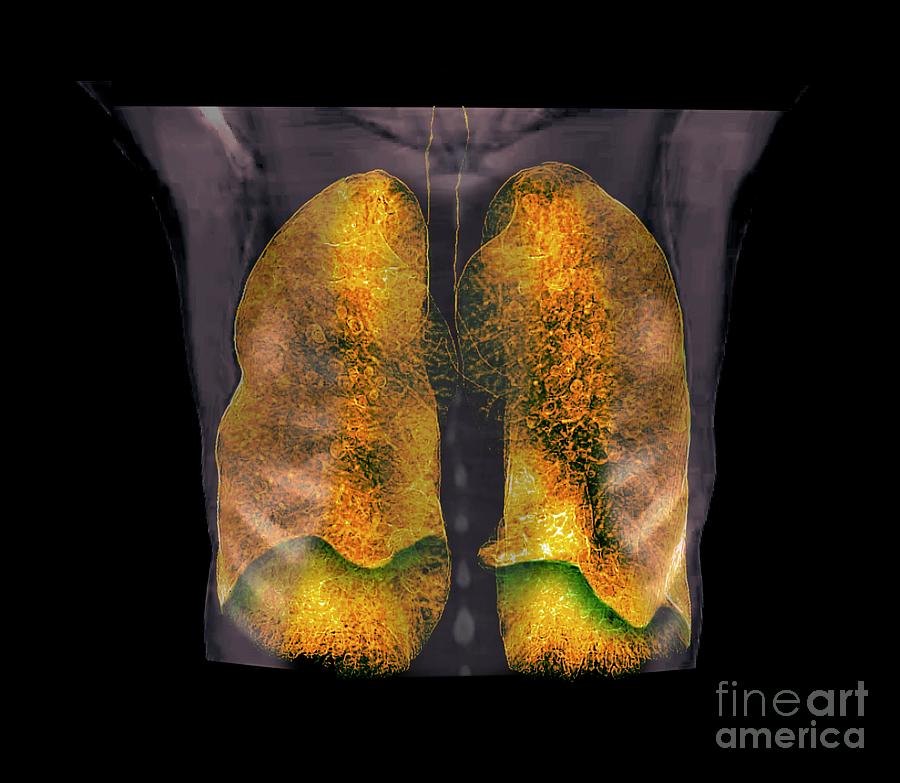 Emphysema Photograph by Zephyr/science Photo Library - Fine Art America