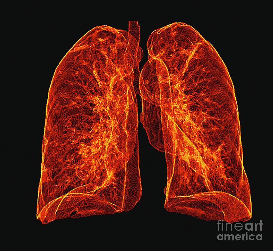 Healthy Lungs Photograph By Zephyrscience Photo Library Pixels 4902