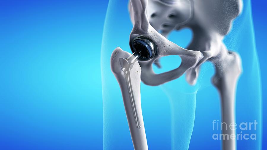 Hip Replacement Photograph By Sebastian Kaulitzki Science Photo Library