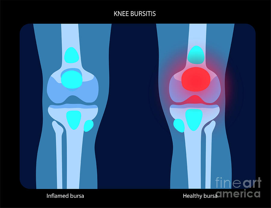 Knee Bursitis #9 Photograph by Pikovit / Science Photo Library