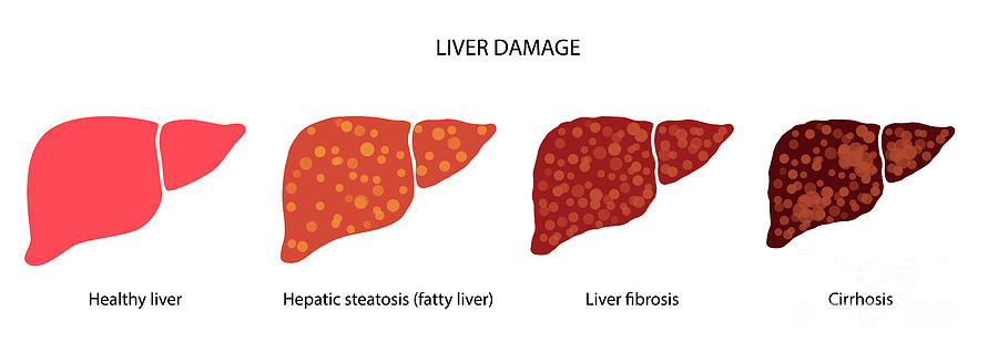 Liver Disease Photograph by Pikovit / Science Photo Library - Fine Art ...