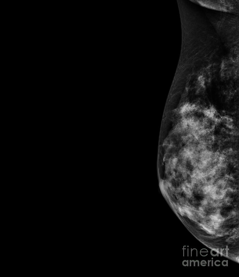 Normal Mammogram Photograph by Samunella/science Photo Library - Fine ...