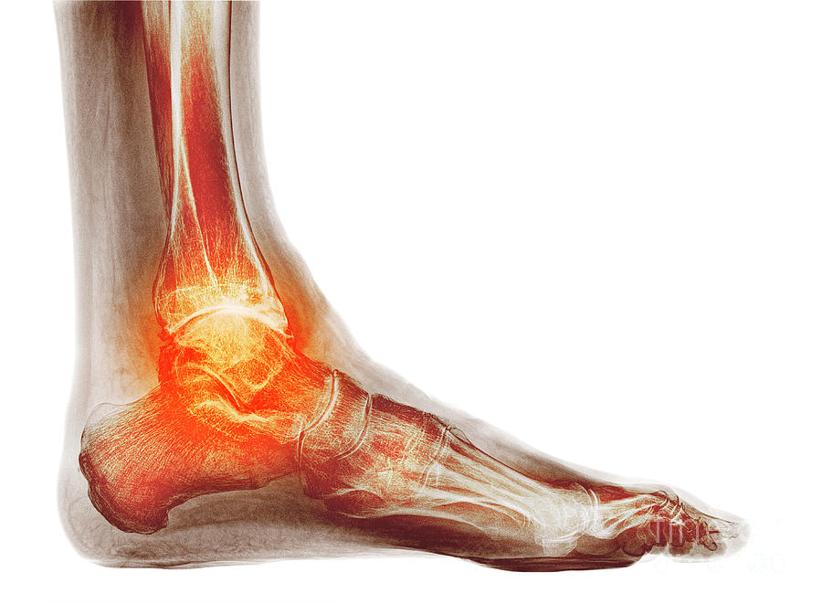 Osteoarthritis Of The Ankle Photograph By Dr P Marazzi Science Photo Library