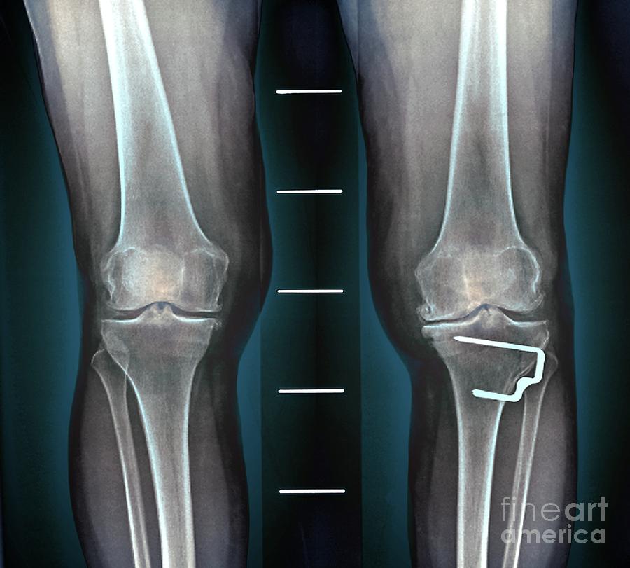 Osteoarthritis Of The Knee Photograph By Zephyrscience Photo Library