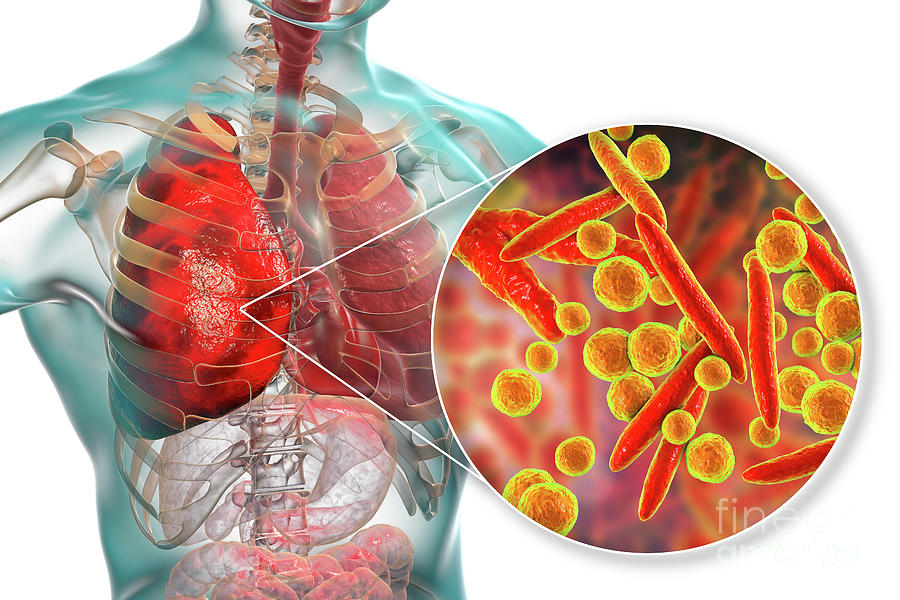 Artwork Photograph - Pneumonia Caused By Moraxella Catarrhalis by Kateryna Kon/science Photo Library Artwork Photograph - Pneumonia Caused By Moraxella Catarrhalis by Kateryna Kon/science Photo Library