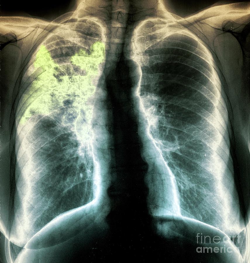 Pneumonia #9 by Science Photo Library