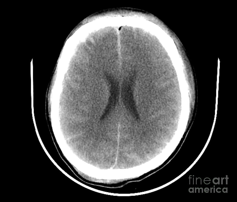 Traumatic Brain Injuries Photograph by Rajaaisya/science Photo Library Fine Art America