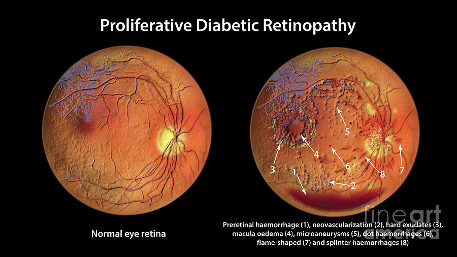 Retina Damage From Diabetes Photograph by Kateryna Kon/science Photo ...