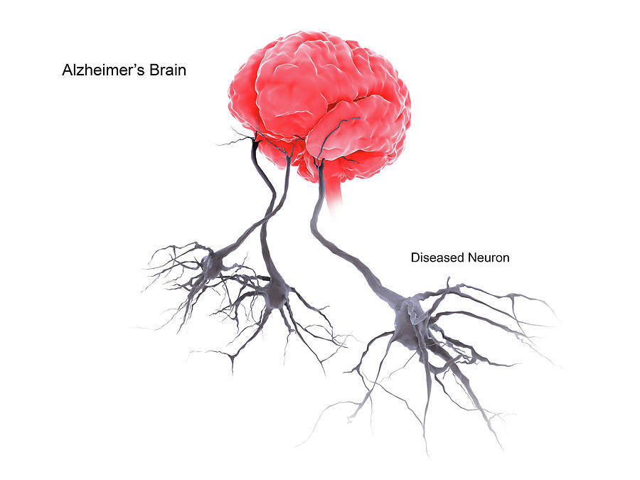 A Brain With Alzheimers Disease Photograph by Stocktrek Images