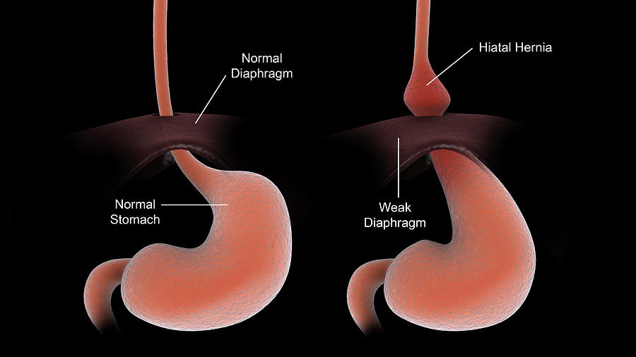 A Healthy Human Stomach Compared To An Photograph by Stocktrek Images