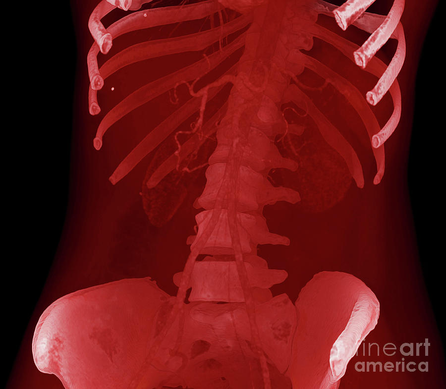 Abdominal Aorta Photograph By Vsevolod Zviryk Science Photo Library Fine Art America