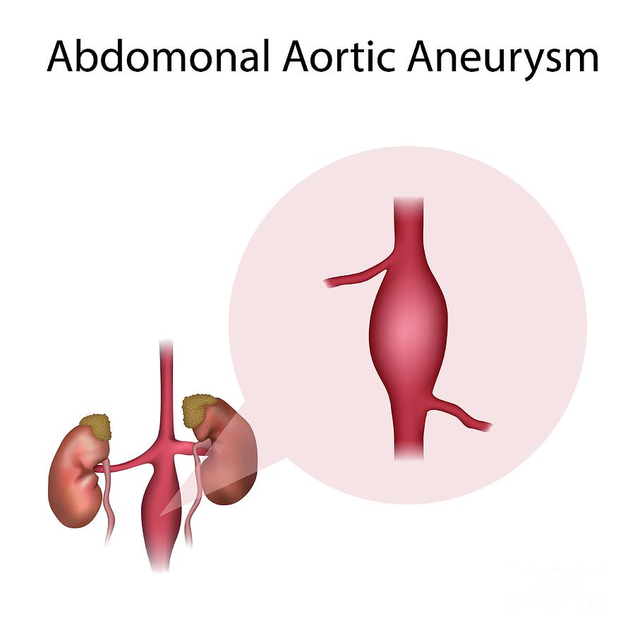 Abdominal Aortic Aneurysm Photograph by Veronika Zakharova/science ...