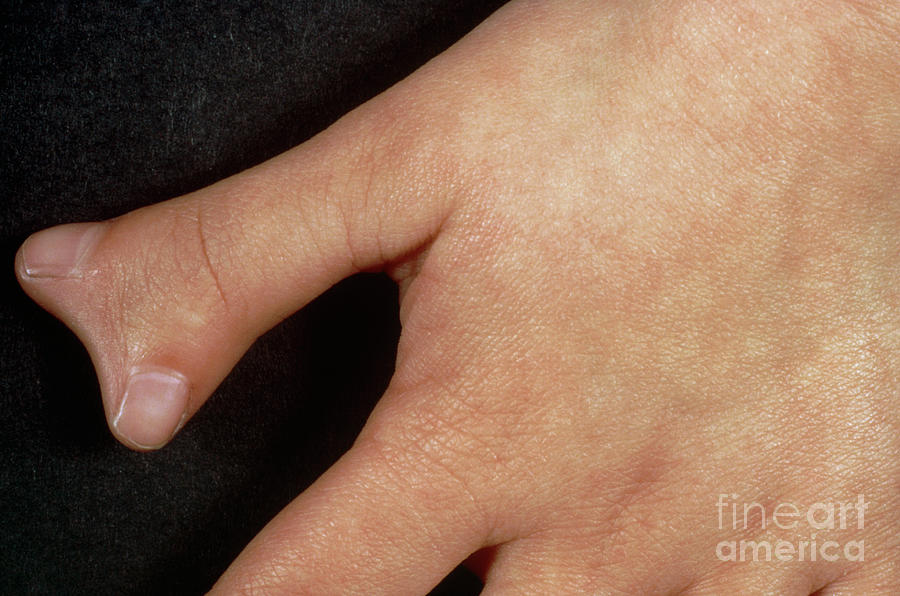 Abnormal Thumb Photograph by Biophoto Associates/science Photo Library