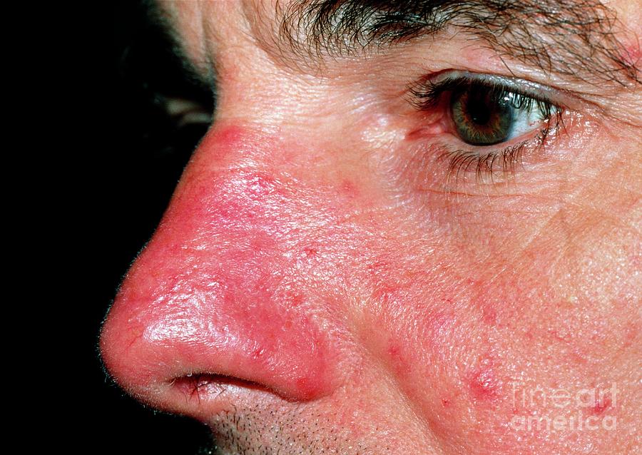 Acne Rosacea Affecting A Mans Nose And Cheeks Photograph By Science