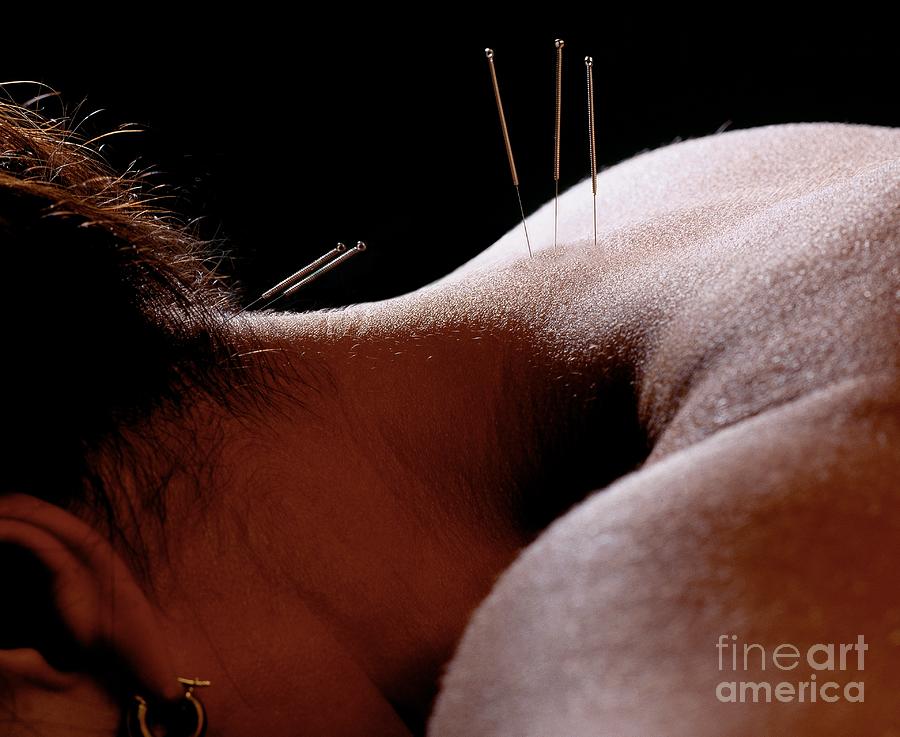 Acupuncture Photograph by Oscar Burriel/science Photo Library