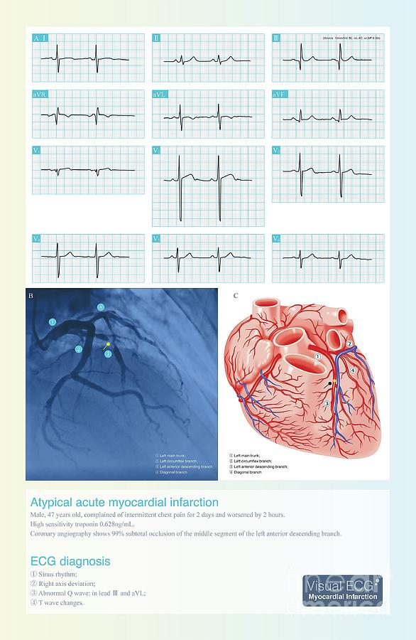 Acute Coronary Syndrome Photograph by Chongqing Tumi Technology Ltd/science Photo Library