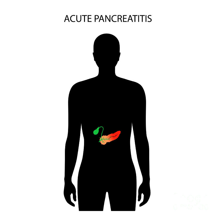 Acute Pancreatitis Photograph by Pikovit / Science Photo Library