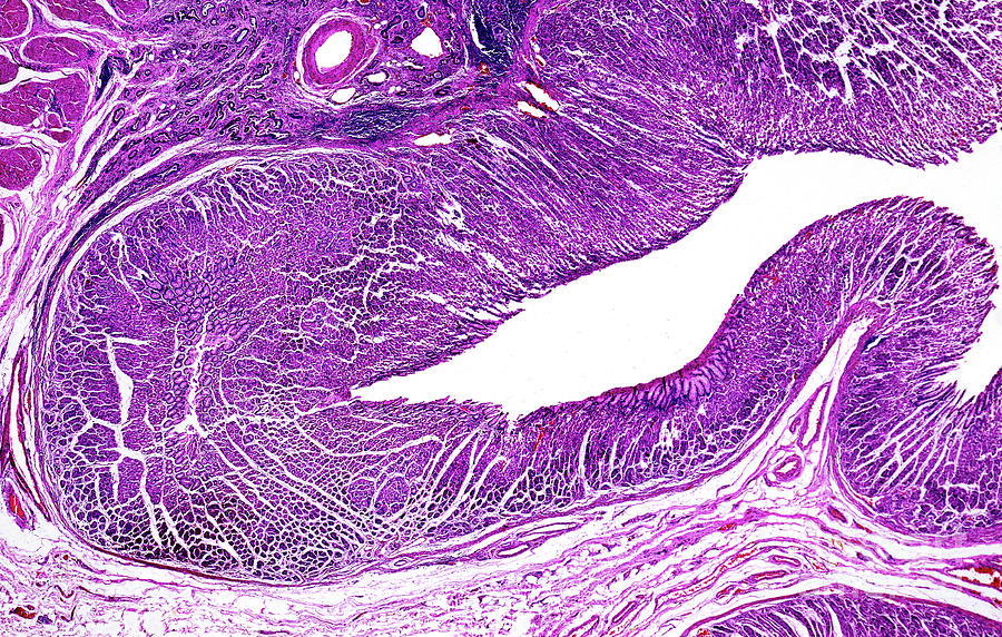 Adenocarcinoma Of The Stomach Photograph By Nigel Downer Science Photo