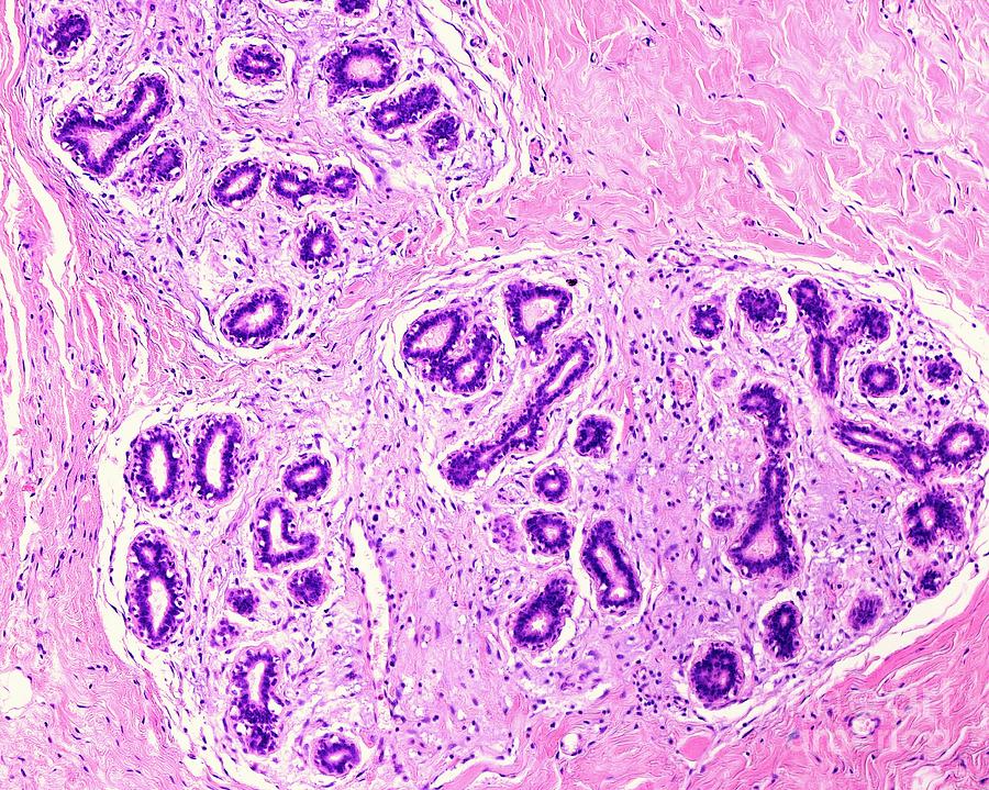 Adenosis Of Human Breast Photograph by Jose Calvo/science Photo Library