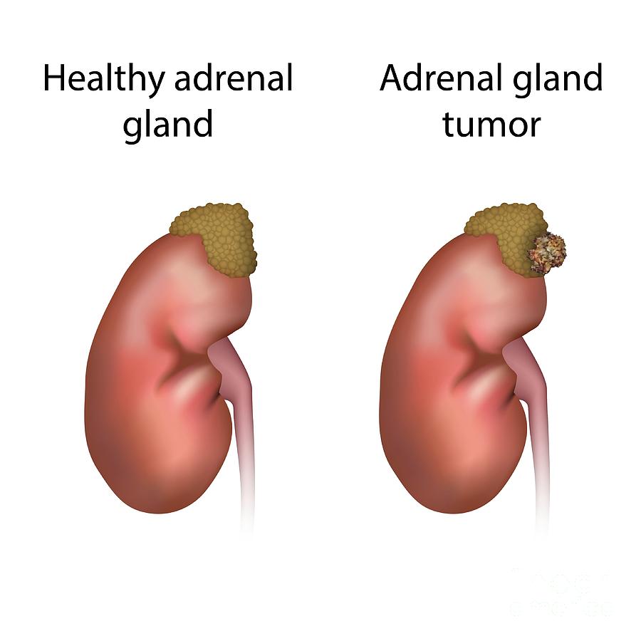 Adrenal Gland Tumour And Healthy Adrenal Gland Photograph by Veronika ...