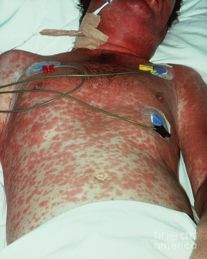 Aids Patient Suffering From Pneumocystis Carinii Photograph by St. Marys Hospital Medical School/science Photo Library