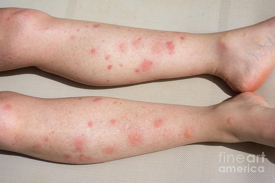 Allergic Reaction To Mosquito Bites. Photograph by David Parker/science Photo Library