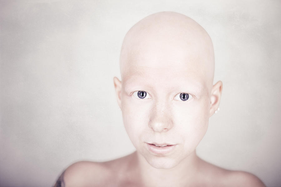 Portrait Photograph - Alopecia Universalis by Kimmo Lundahl