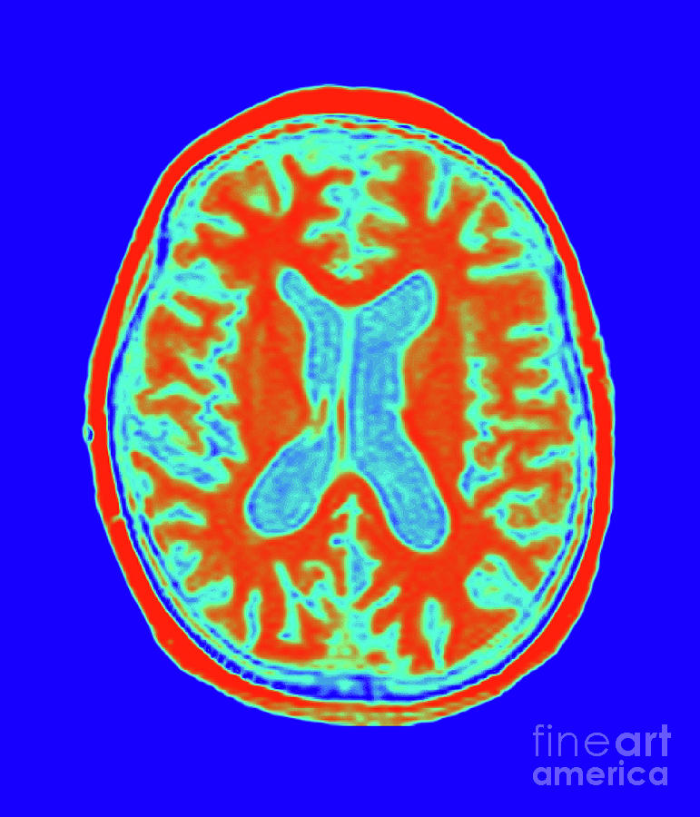 Alzheimers Disease Mri Photograph By Dr W Crum Dementia Research