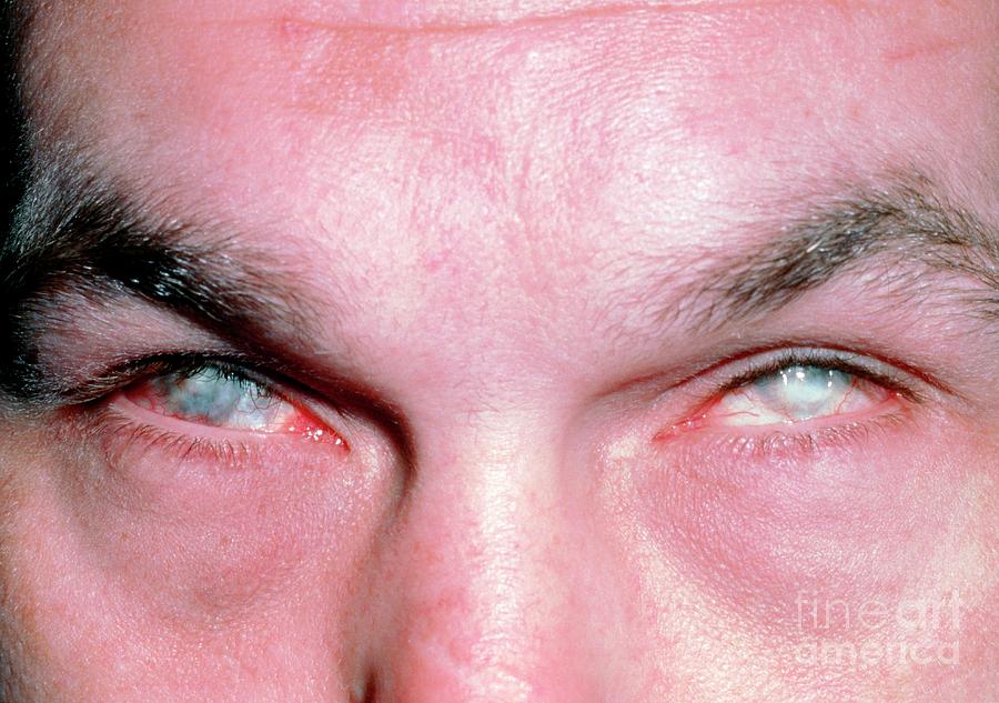 Ammonia Burns To A Man's Eyes Photograph by Western Ophthalmic Hospital ...