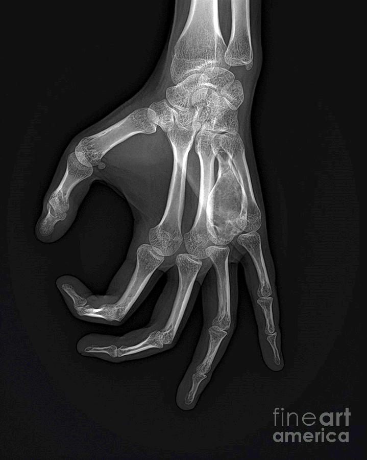 Aneurysmal Bone Cysts Of The Hand Photograph By Rajaaisya Science Photo 