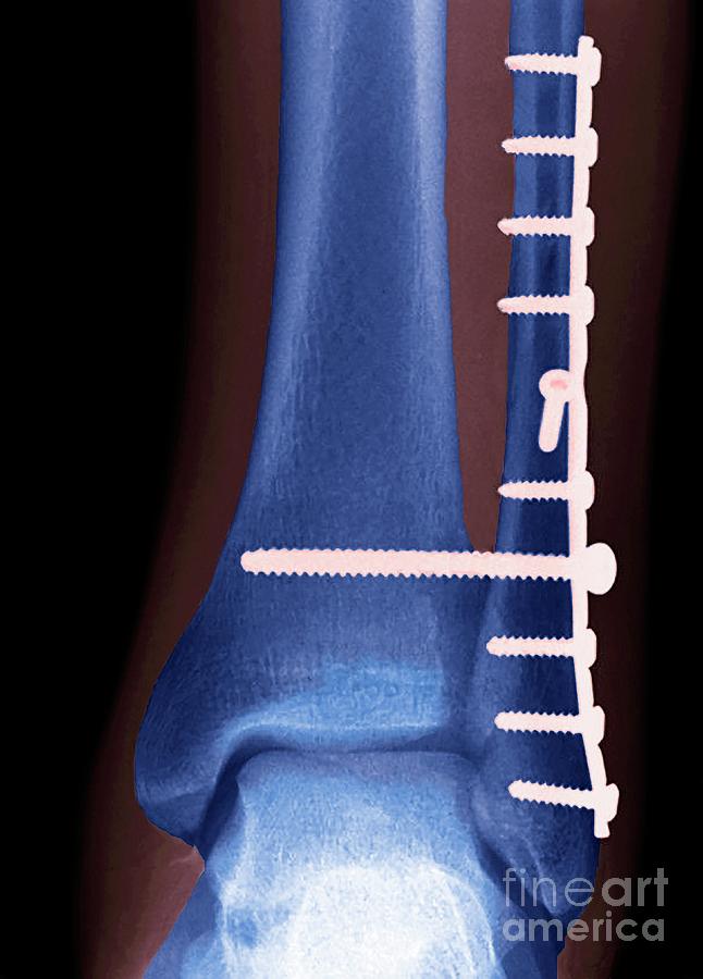 Ankle Fracture Photograph by Steve Gschmeissner/science Photo Library