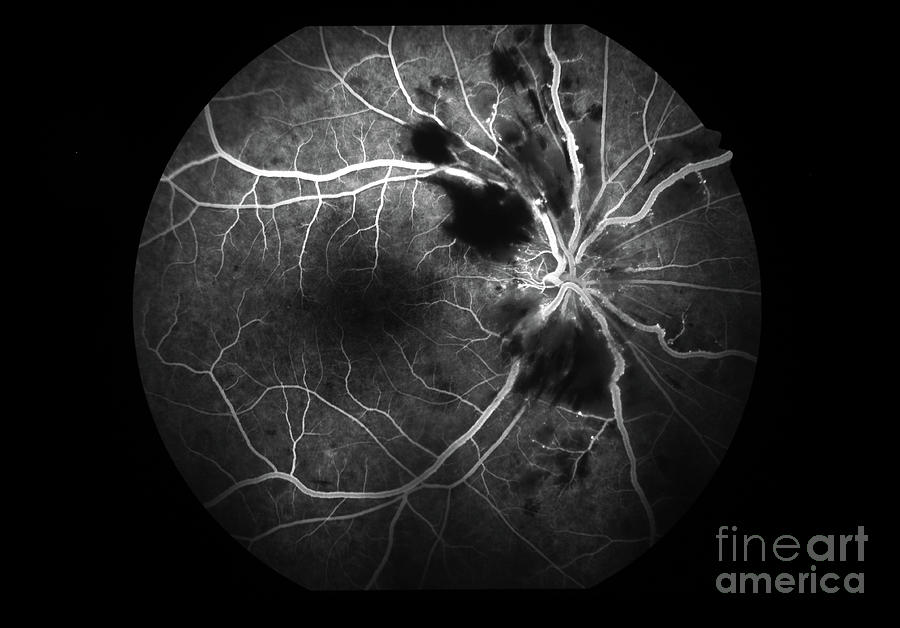 Anterior Ischemic Optic Neuropathy Photograph By Alan Frohlichstein