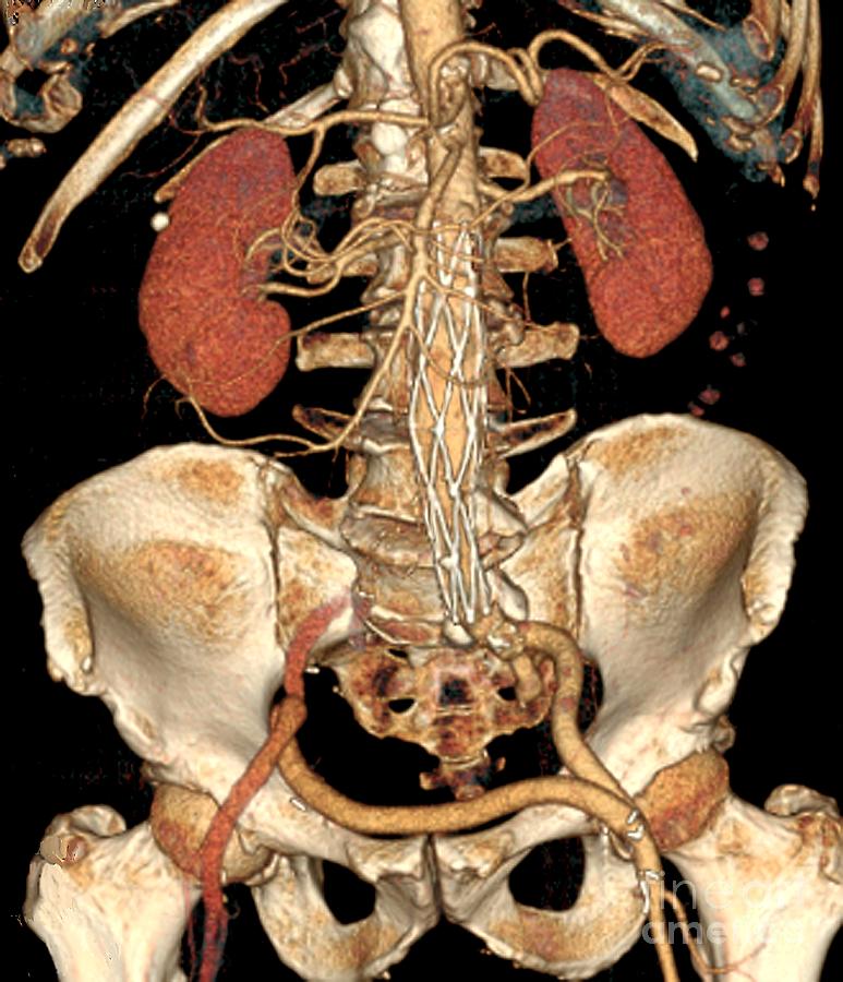 Aortic Abdominal Aneurysm Photograph by Zephyr/science Photo Library ...