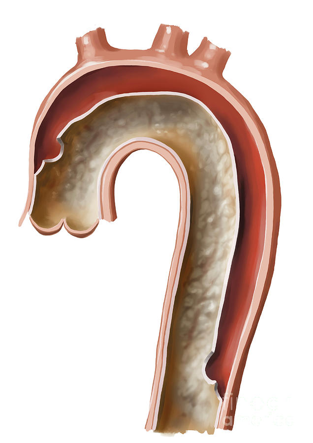 Aortic Dissection Photograph By Medical Graphicsmichael Hoffmannscience Photo Library Fine 5253