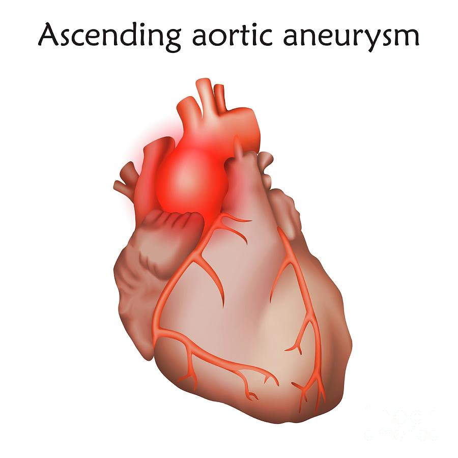 Ascending Aortic Aneurysm Photograph by Veronika Zakharova/science ...