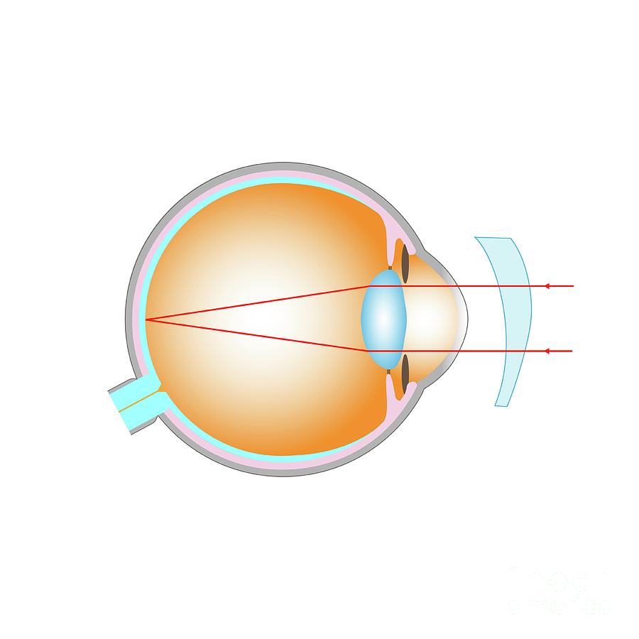 Astigmatism Corrected With A Lens Photograph by Cordelia Molloy/science ...