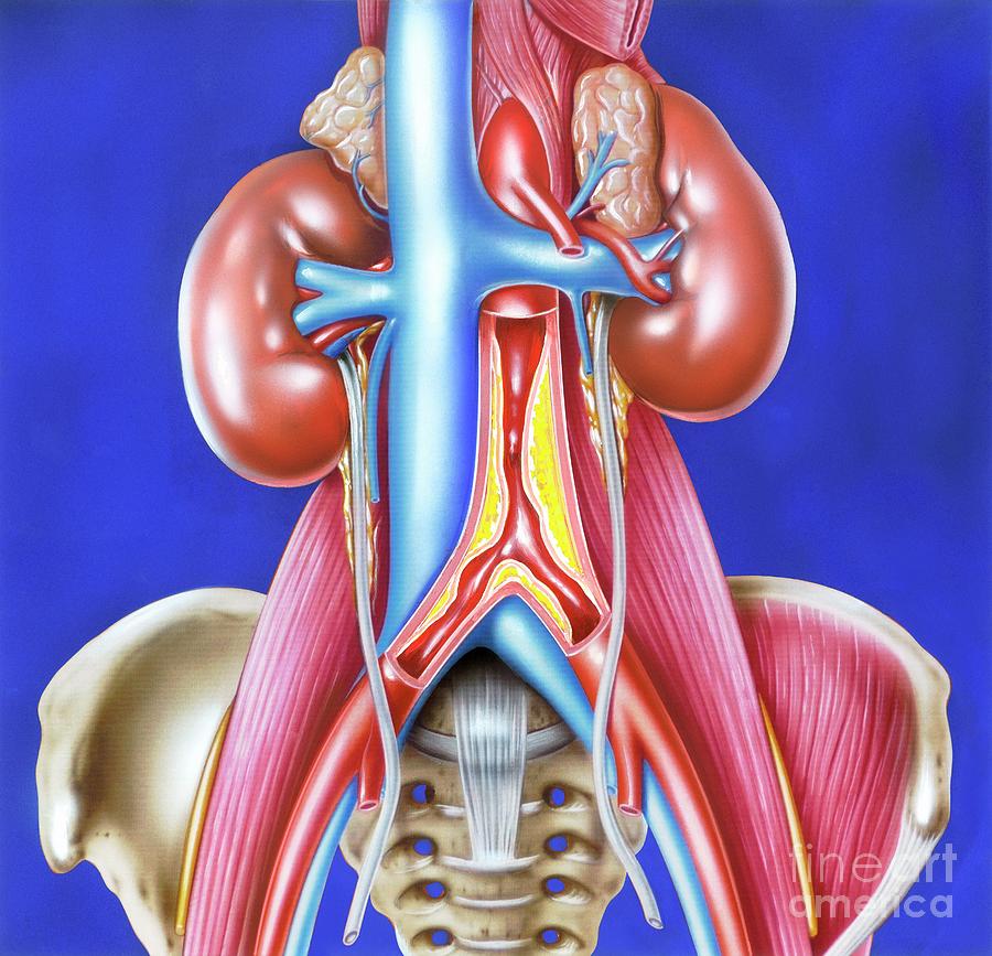 Atherosclerosis In Aortic Junction By John Bavosiscience Photo Library